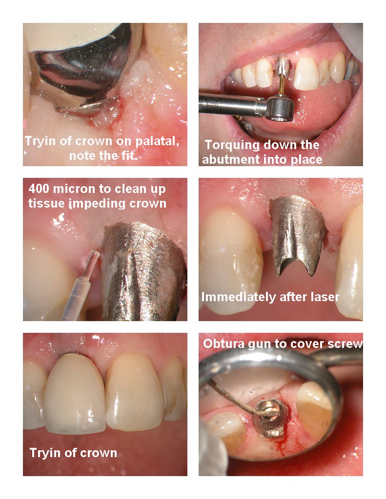 Implant pg 3.jpg